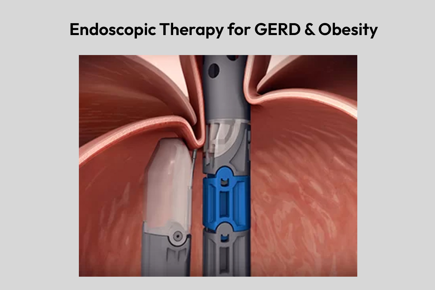 Endoscopic Therapy for GERD & Obesity