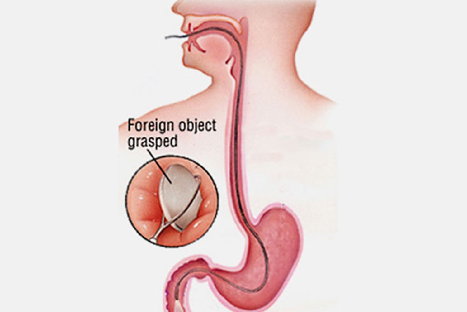 Foreign body removal