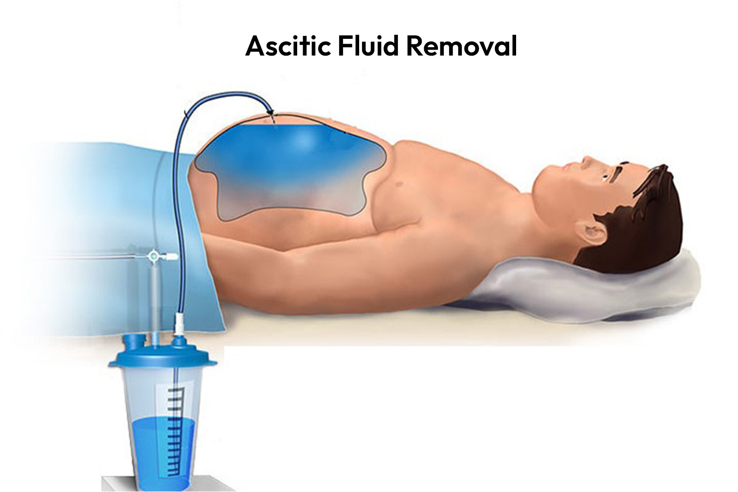 Ascitic Fluid Removal