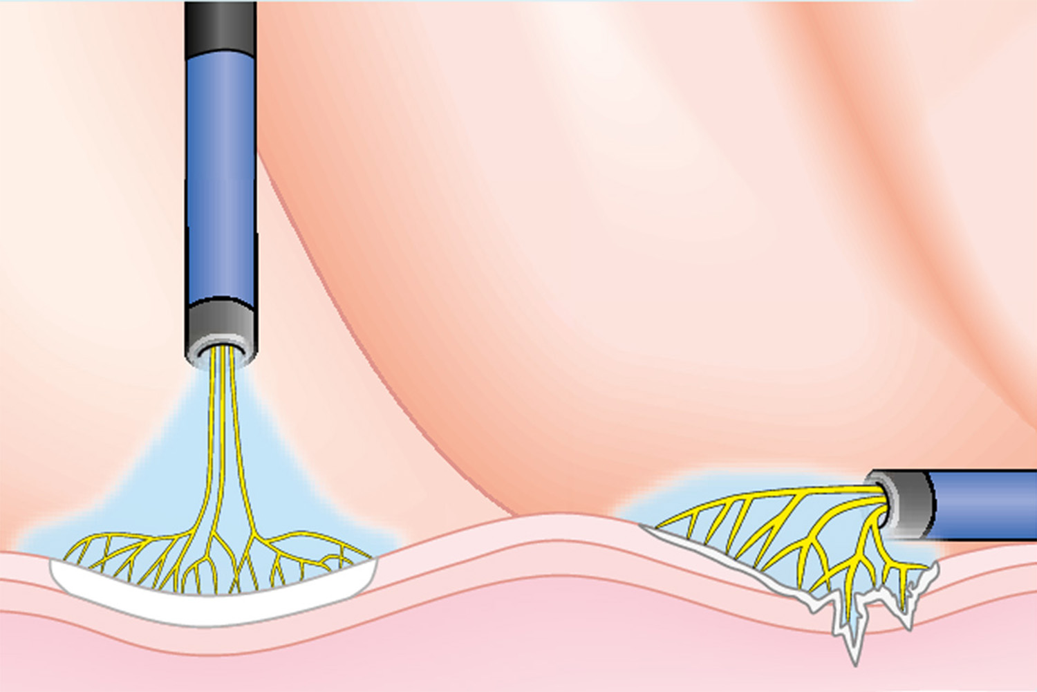 Argon Plasma Coagulation